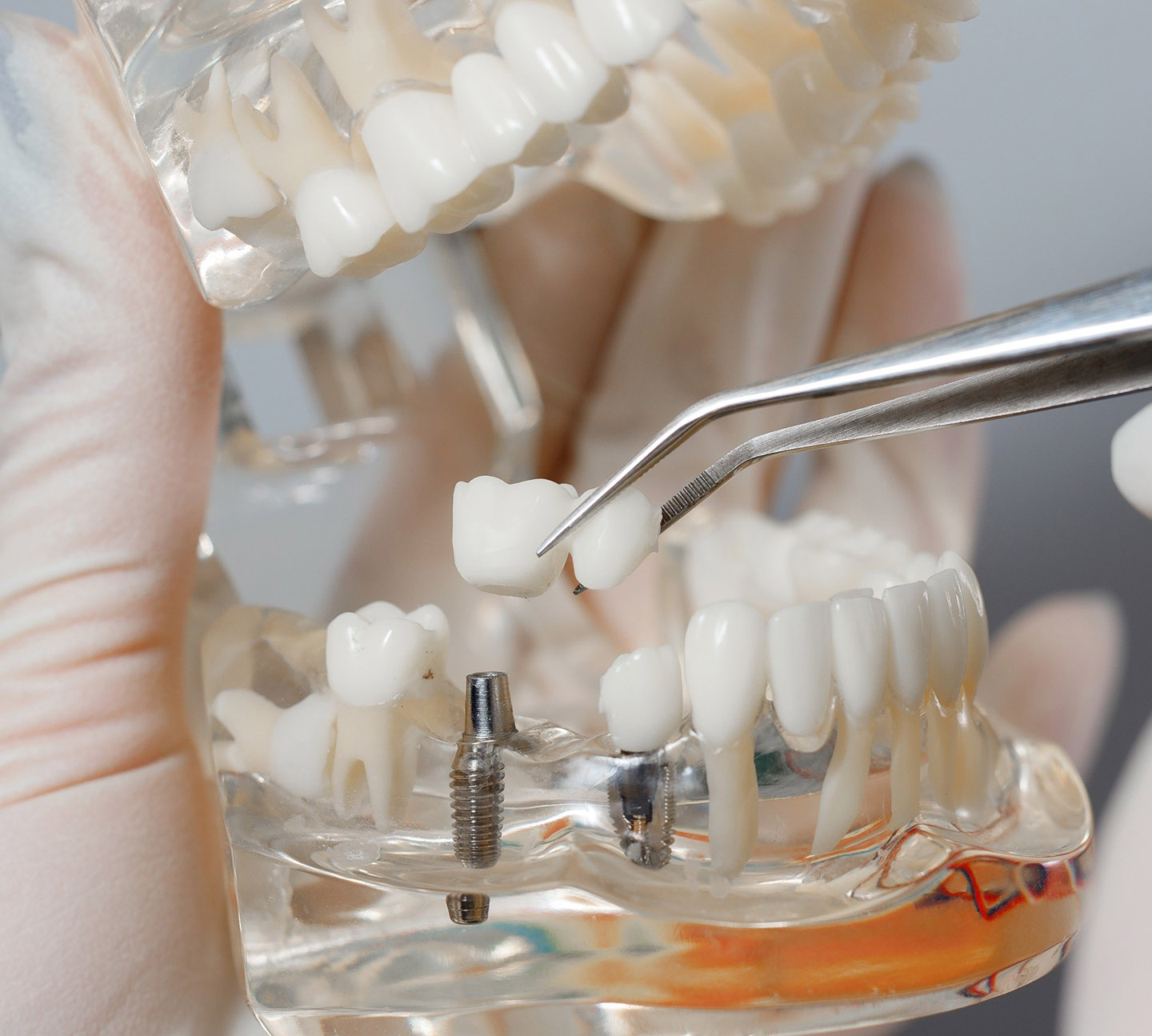 Ортопедия зубов